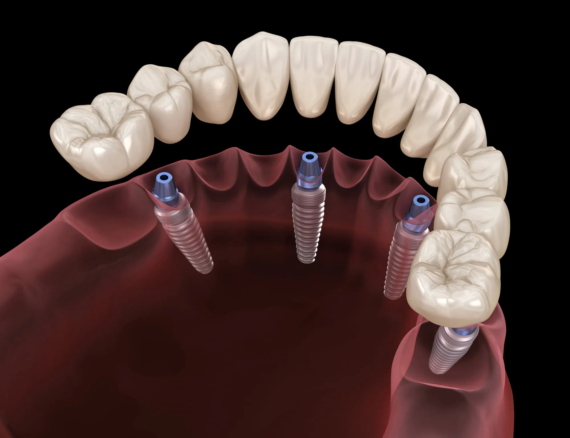All-on-4® Dental Implants