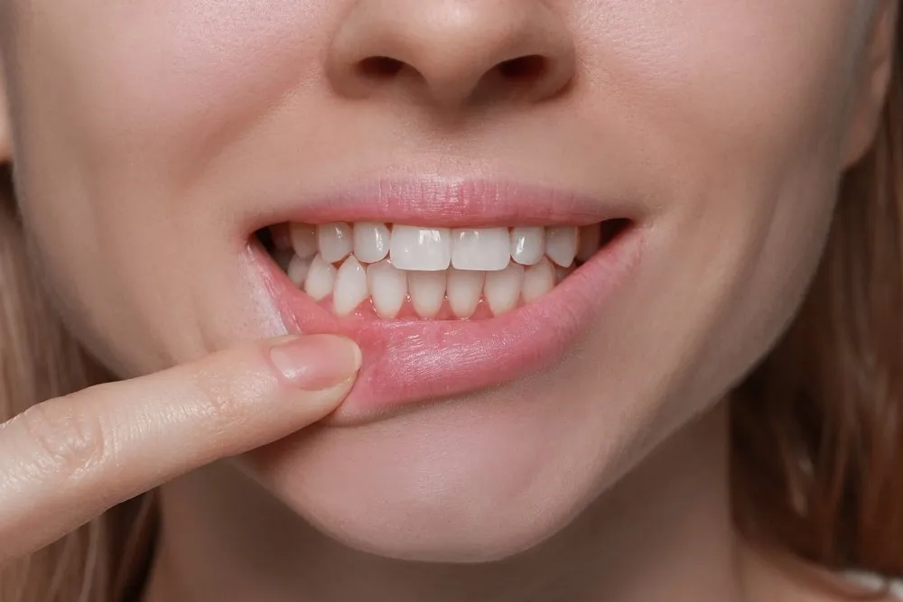 Gum Contouring — what to know