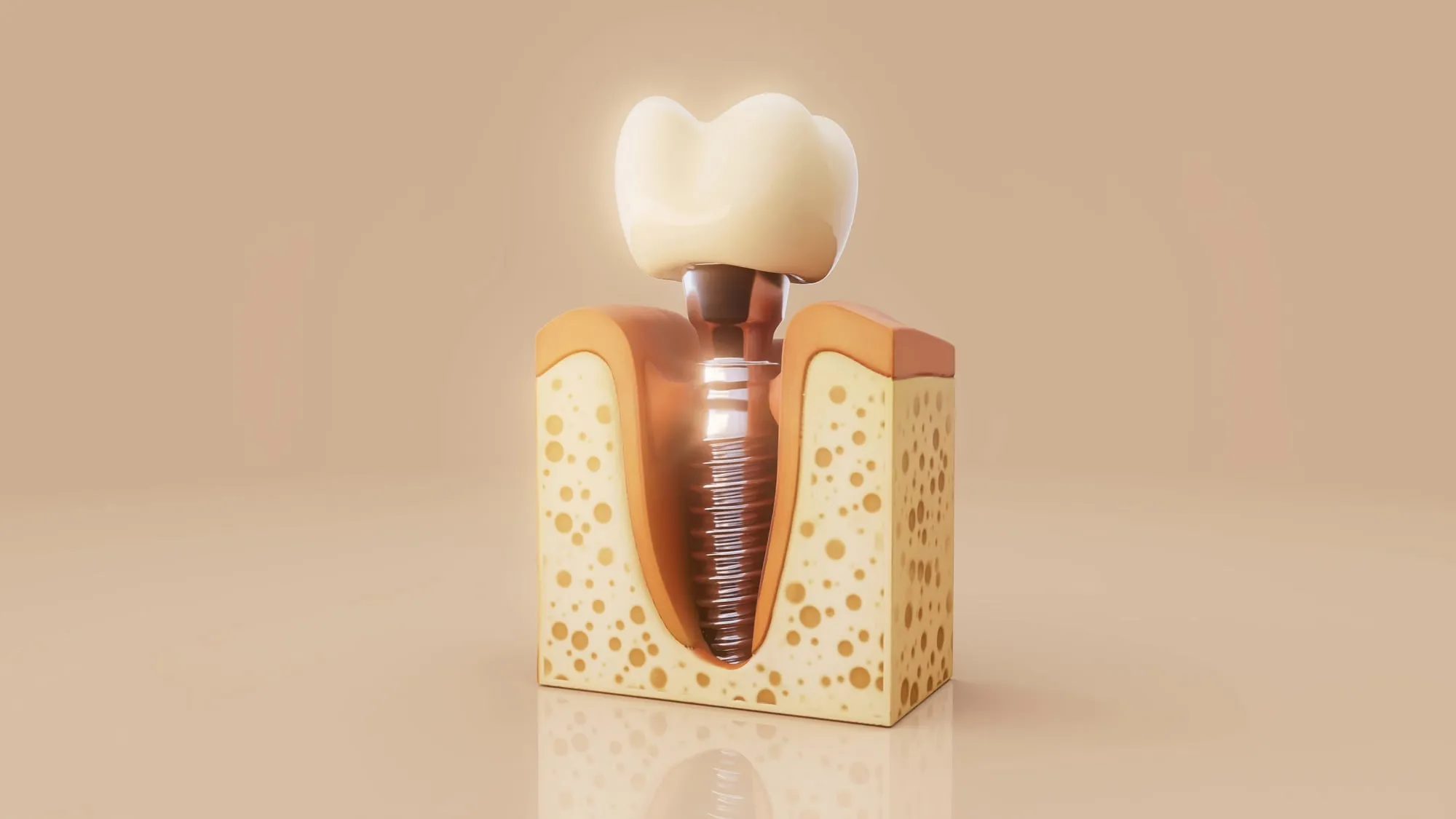 Dental Implants — our approach