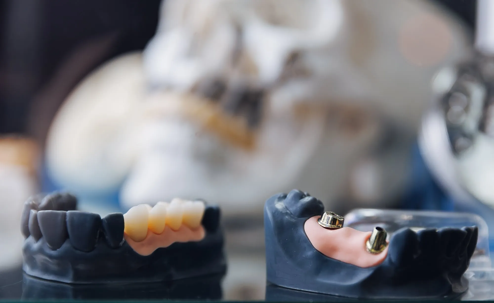 Dental Implants