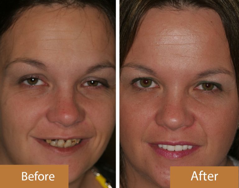 Before And Afters Bowling Green, KY Chandler Park Dental