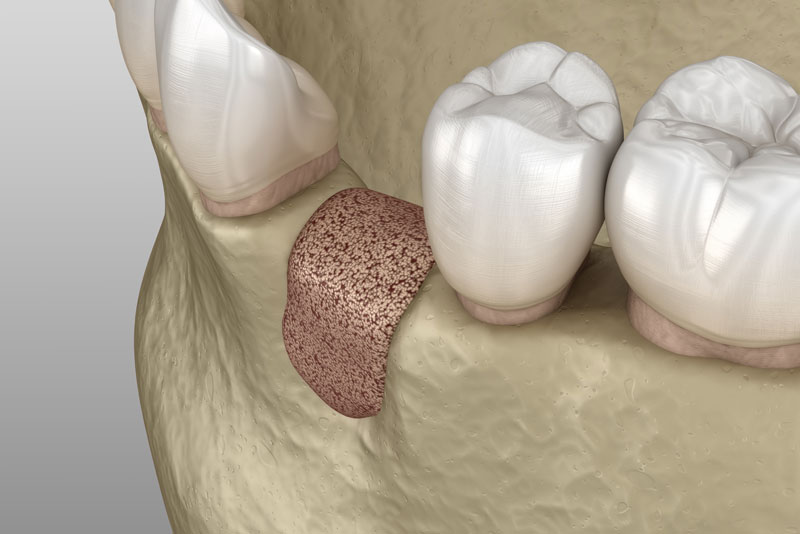 a picture of a bone graft model that shows the bone graft site surrounded by natural teeth. the site of the bone graft can be treated with dental implants.
