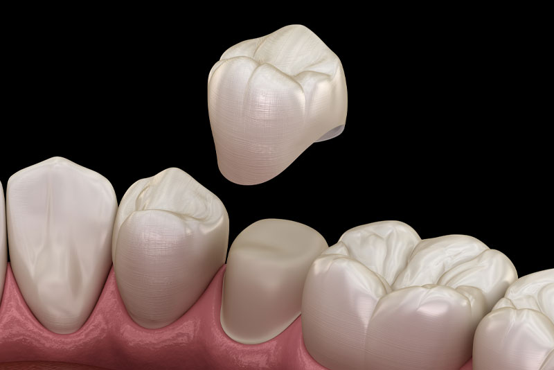 An image of same-day dental crowns.