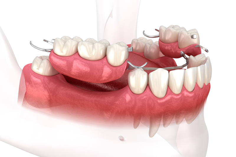 Close-up 3d image of a dental implant bridge on both sides of the bottom teeth
