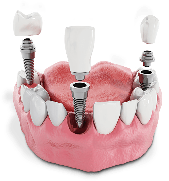 Multiple Dental Implants Above The Gum Line