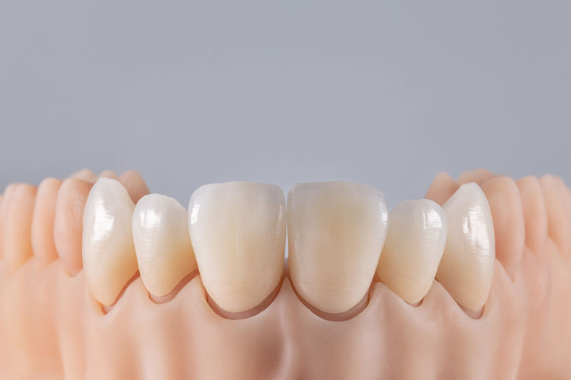 Six ceramic crowns on silicone gums. Dental model of teeth front view. Grey background