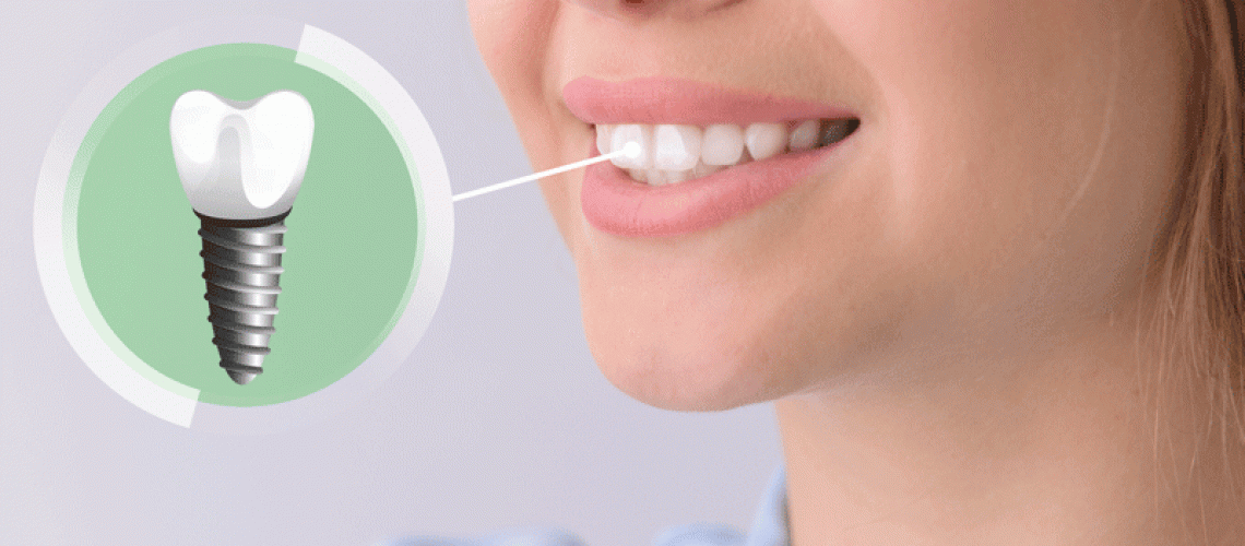 Young woman with implanted teeth on color background, closeup.