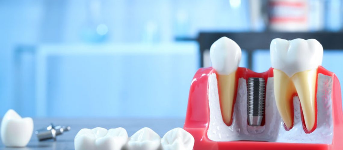 The image features a dental model with teeth, including dental implants in the jaw section, alongside extracted teeth. It is likely used for educational purposes in dental clinics or schools.