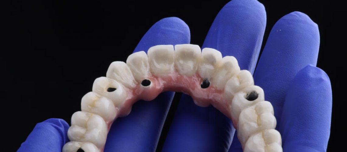 Photo dental implant work is completed and ready to use dental implant temporary abutment, a doctor with blue gloves on holding hand flat