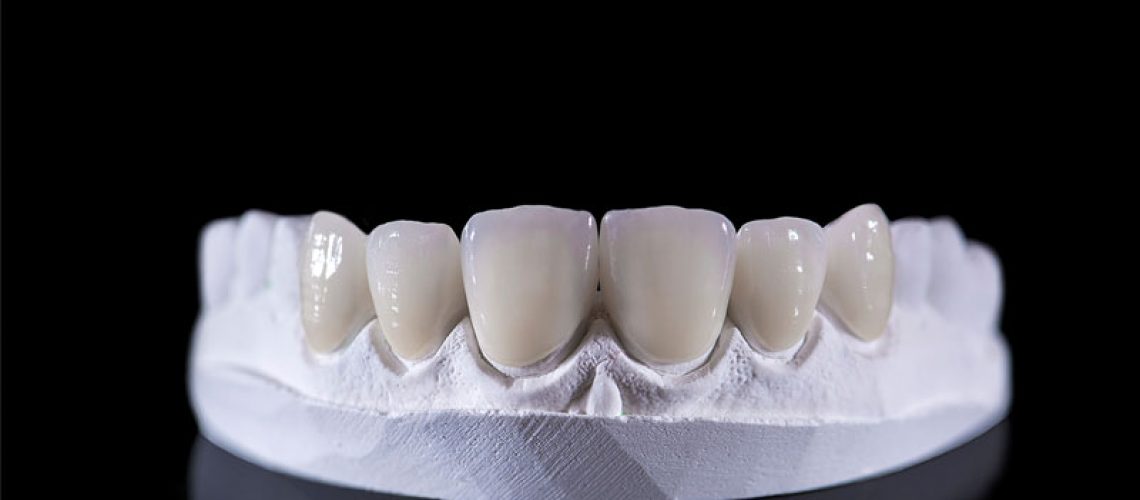 Dental veneers on a upper jaw model; laying on a black reflective table.