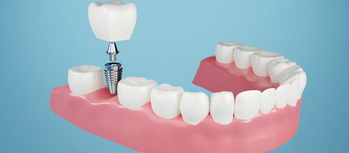3d model of a lower jaw with a dental implant in the molars.