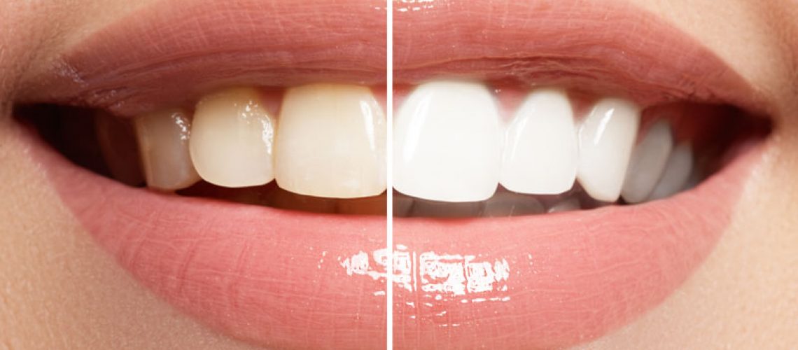 Close-up of a smile showing the dramatic difference between teeth before and after professional whitening, highlighting the transformation to a brighter, whiter smile.
