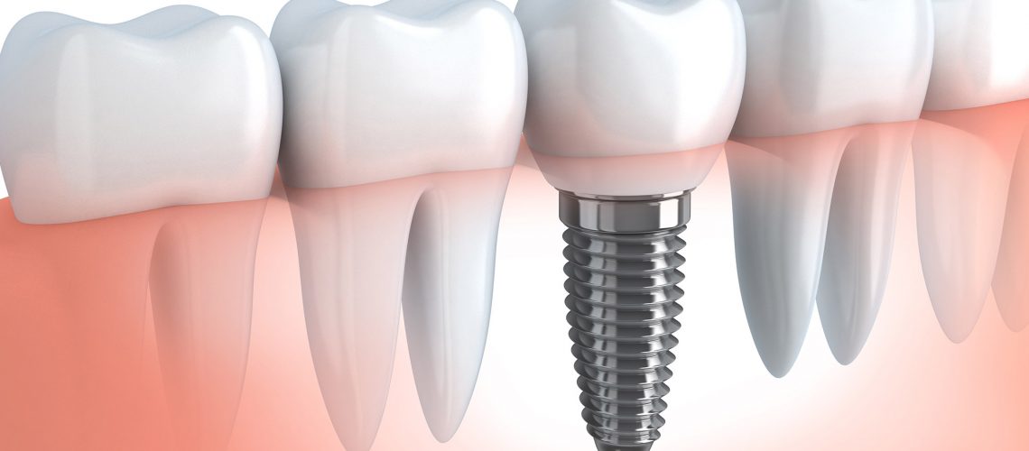 Dental implant illustration