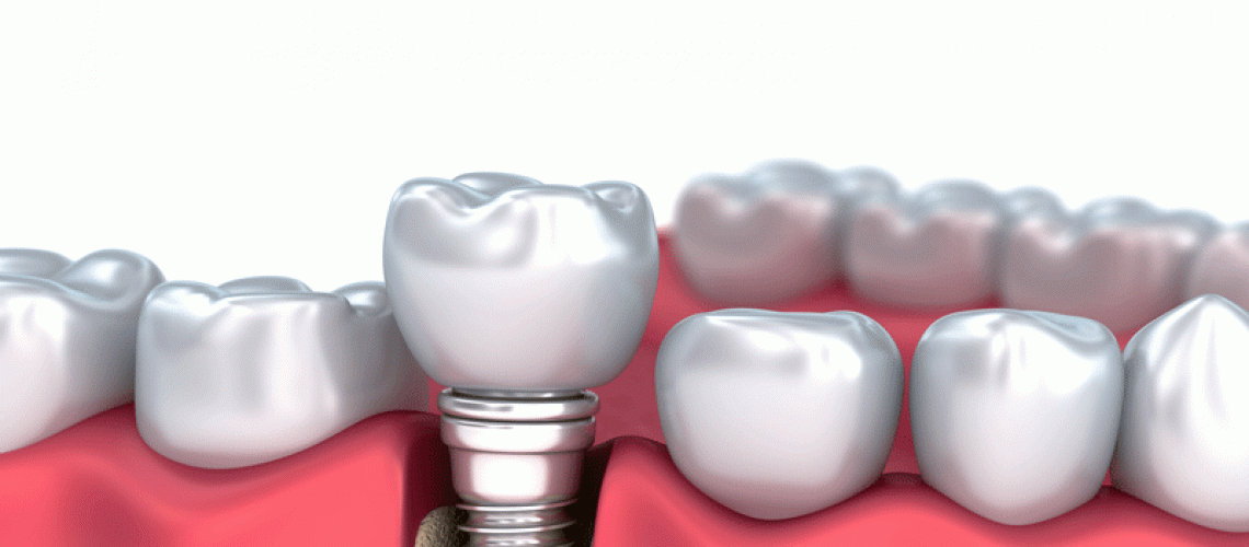 Medically accurate 3D illustration of a Dental Implant