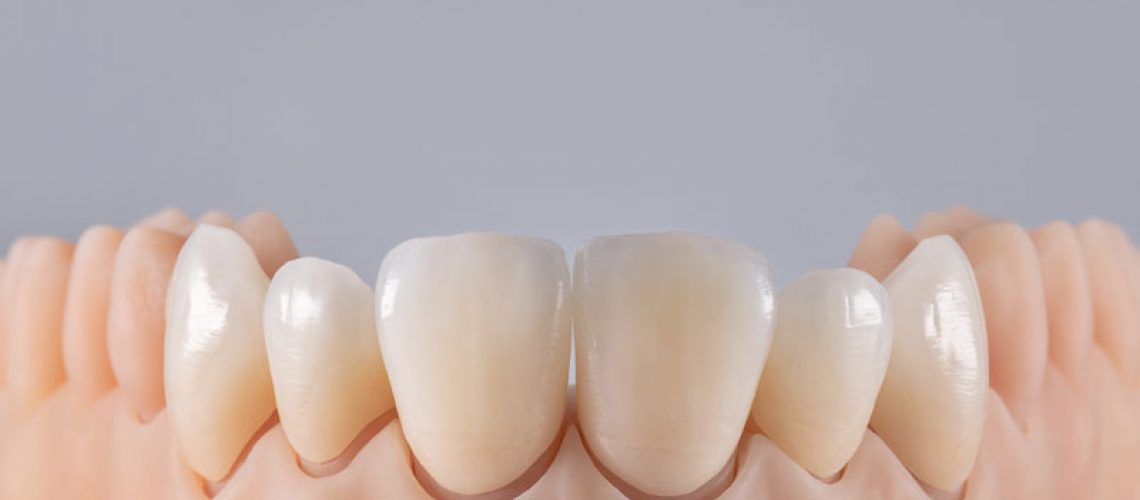 Six ceramic crowns on silicone gums. Dental model of teeth front view. Grey background