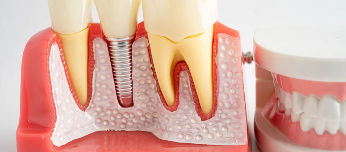 a single dental implant with a full arch of teeth sitting next to it