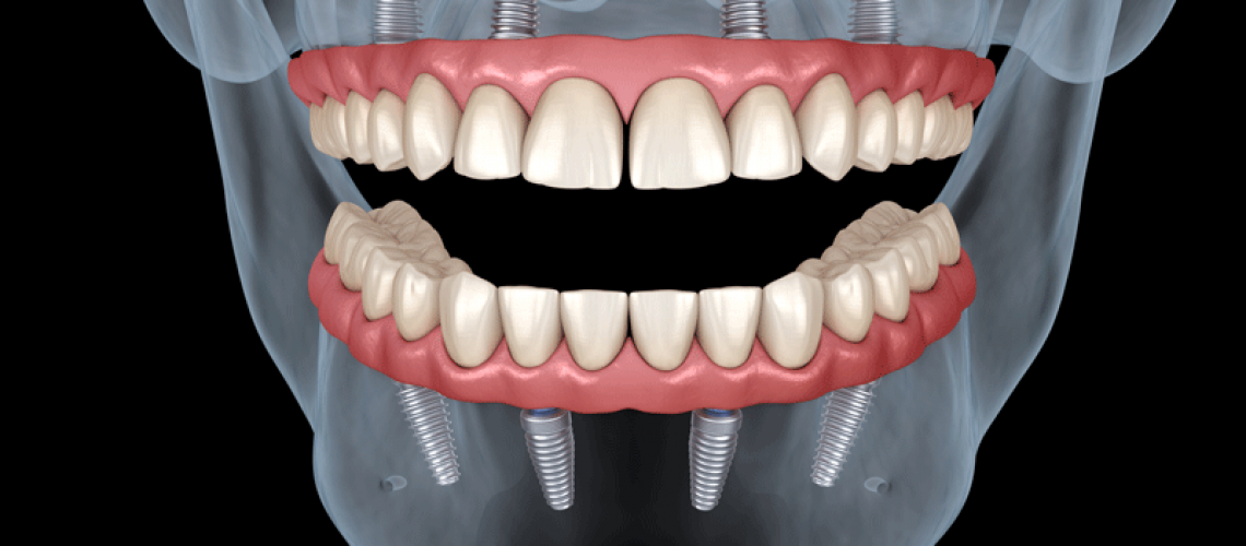 An image of full mouth dental implants on a 3D facial model.