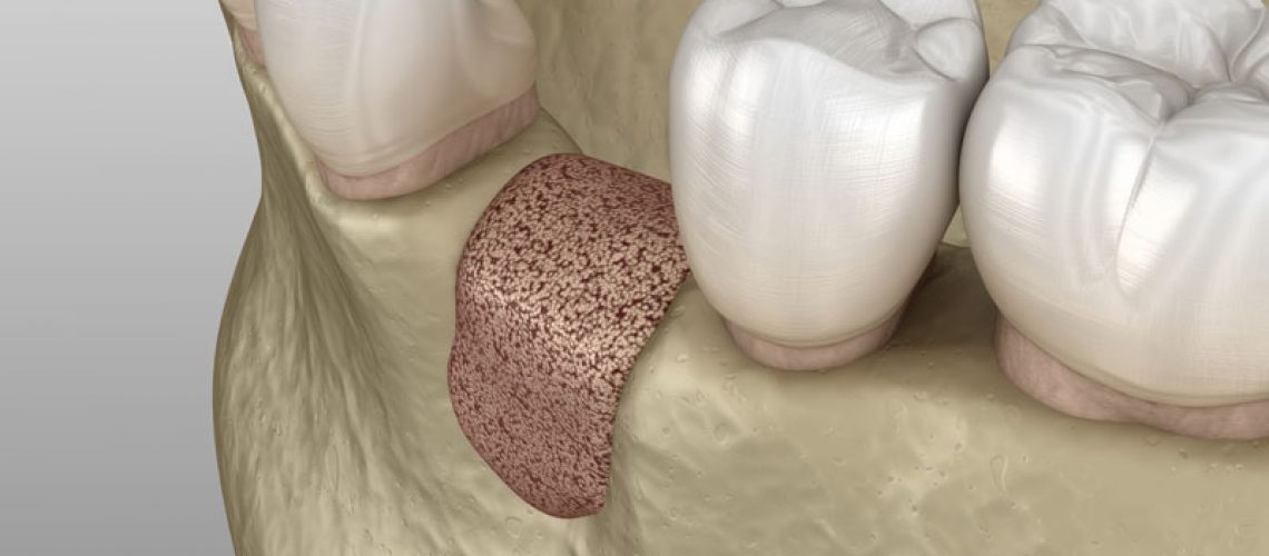 a picture of a bone graft model that shows the bone graft site surrounded by natural teeth. the site of the bone graft can be treated with dental implants.