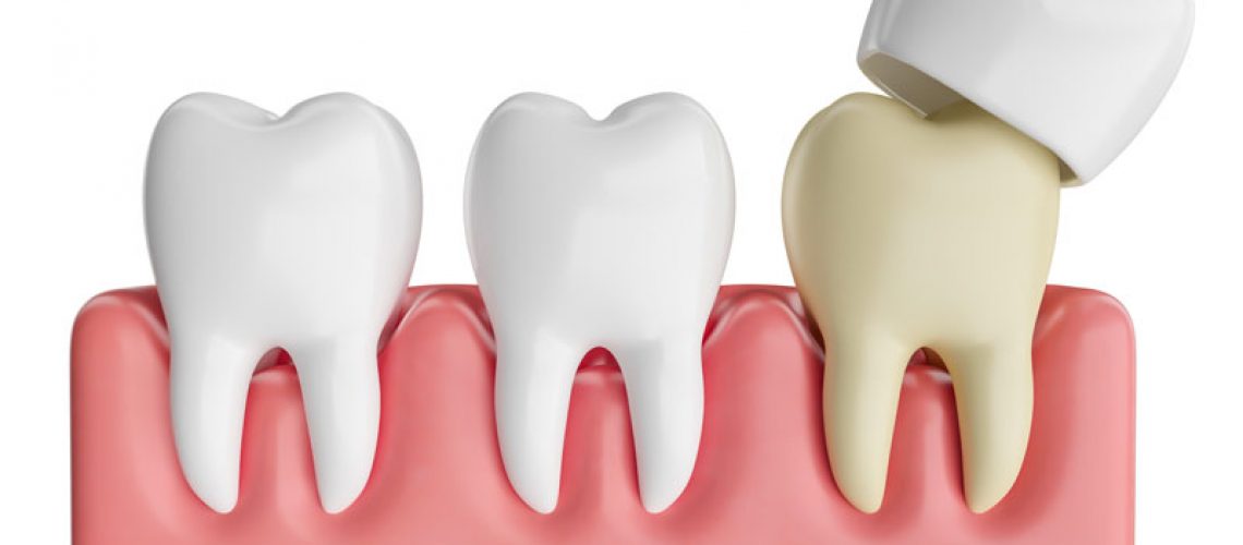 a crown being placed on a damaged tooth
