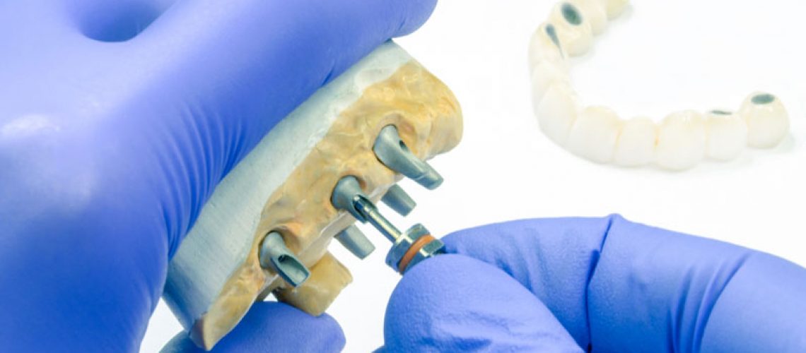 a custom dental implant model being customized by a dental professional.