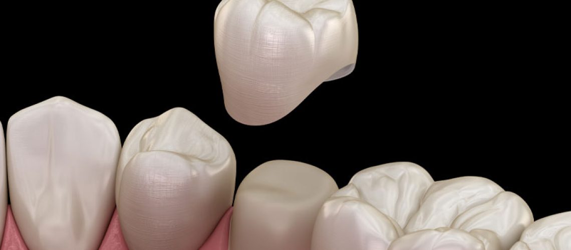 An image of same-day dental crowns.