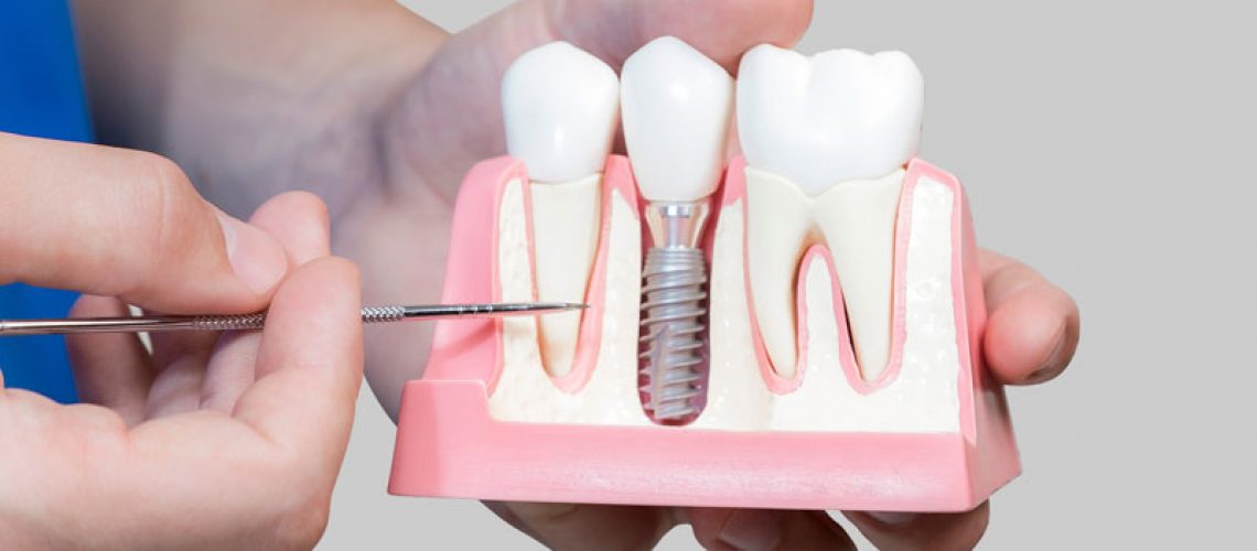 a dentist holding a jawbone cutaway model showing a single dental implant post and crown prosthetic.