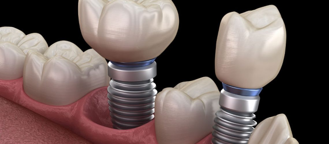 a digital model of a lower jaw showing two dental implant posts.