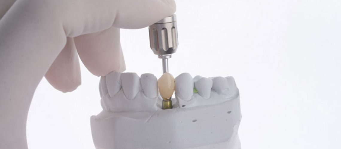 a single dental implant with a tool being shown to place it into the mouth