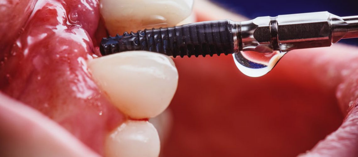 a single dental implant with a drill placing it into the mouth